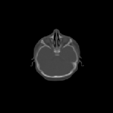 \scalebox{0.40}{\includegraphics{figs/skulls/WesselCa1_tr_256Tns116}}