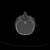 \scalebox{0.40}{\includegraphics{figs/skulls/s2_s1defTns116}}