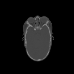 \scalebox{0.375}{\includegraphics{trans_paper01.figs/skulls/FreeVa1_newtrTns116}}